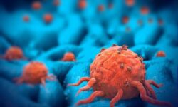 لزوم بازنگری جدی در روش‌های درمانی «سرطان پروستات»