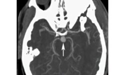 «آنوریسم مغزی» چیست؟/ علائم شایع و ۲ عامل خطر مهم آن