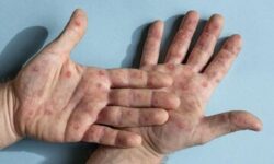 شیوع آبله میمون در ایران؛ محرز:‌ وحشت نکنید! ماسک بزنید | وزیر بهداشت آماده باشد