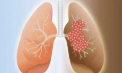 تشخیص بیماری فیبروز ریه با روشی نوین در بوشهر